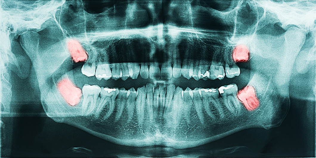 Pano xray