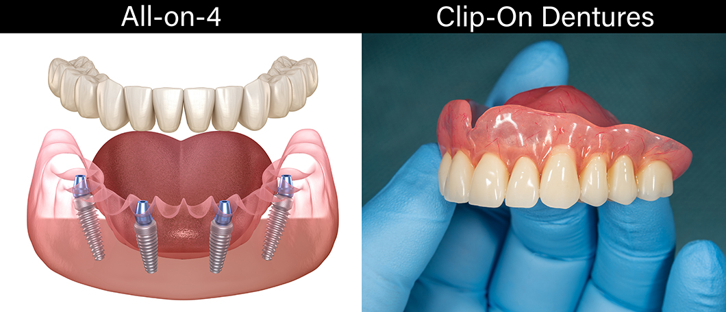 All on 4 vs dentures